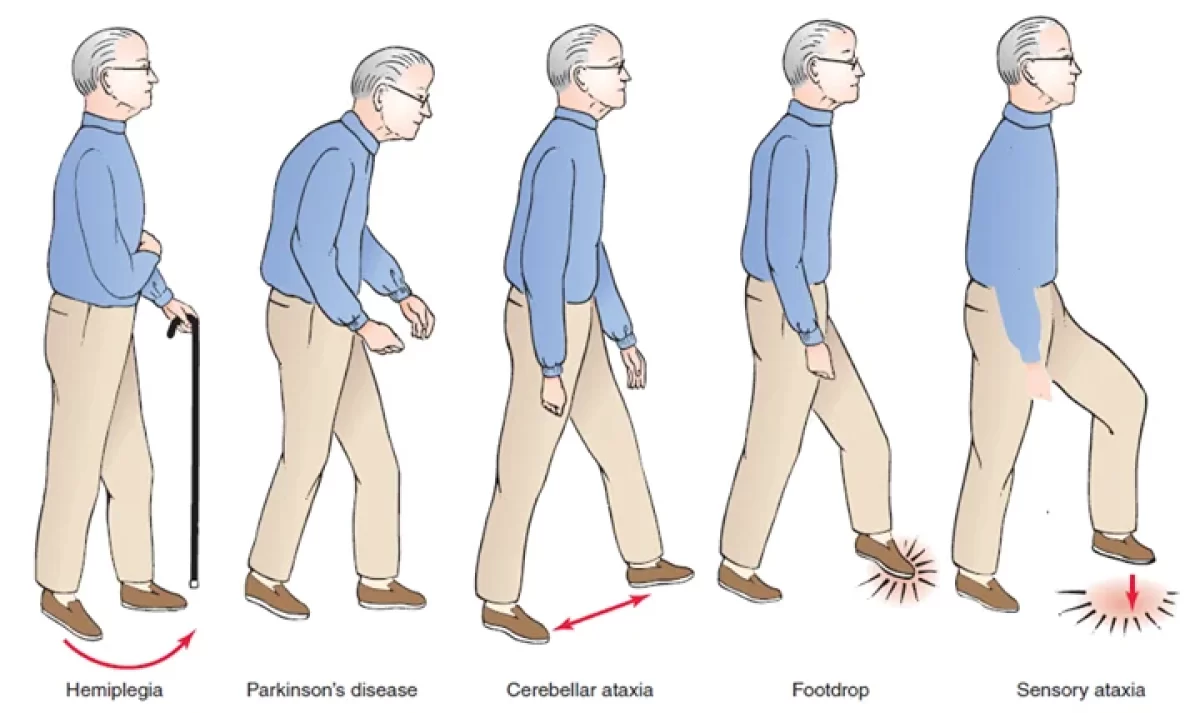 Gait and Posture Biomechanical Analysis