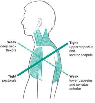 Upper Crossed Syndrome Biomechanics